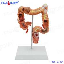 PNT-07451 Modelo intestinal humano Modelo de intestino grueso enfermo para educación